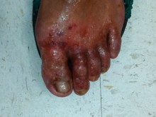 Many of the farmworkers had severe rashes on their feet from pesticide/fertilizer runoff.