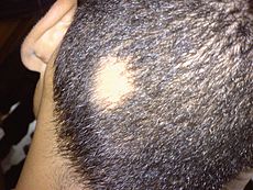 Individuals face the health care costs of treating alopecia areata and, if the individual chooses, wearing a cranial prosthesis.