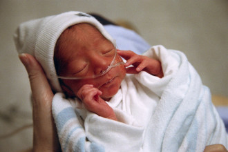 A premature infant. Photo courtesy of the March of Dimes