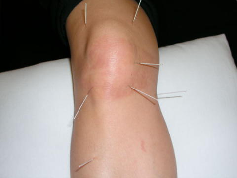 Acupuncture