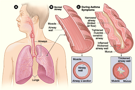 Asthma attack illustration